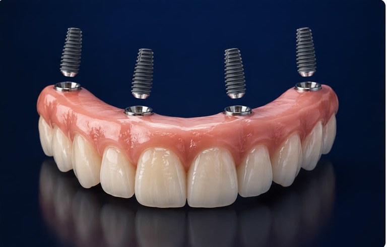 All-on-4 — full arch of fixed teeth on 4 implants