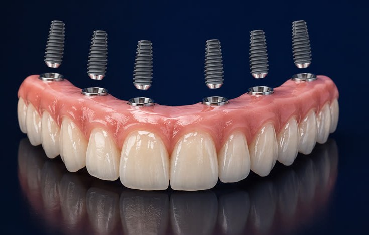 All-on-6 — full arch of fixed teeth on 6 implants