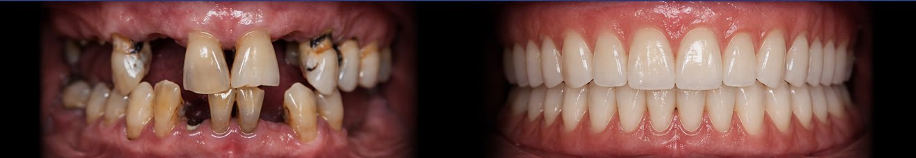 All-on-6 — dental view before and after