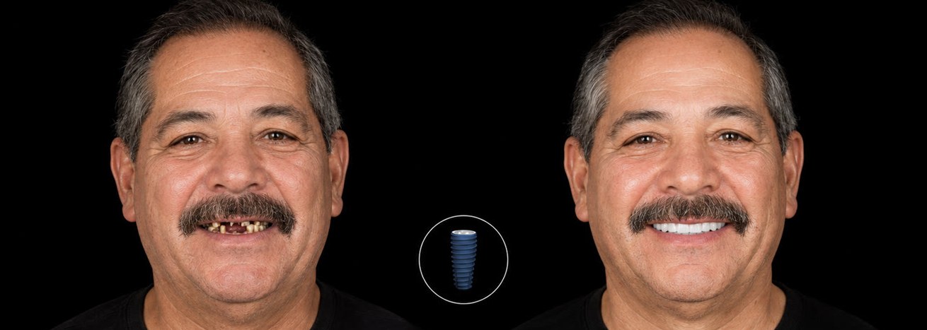 All-on-6 transformation — before and after