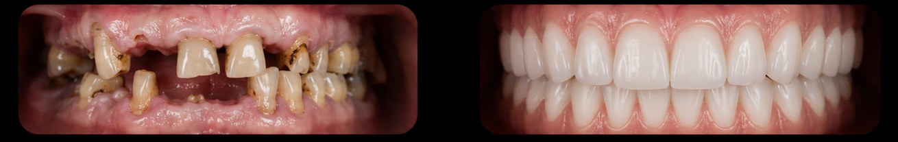 All-on-6 — dental view before and after