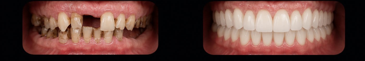 Fixed teeth on 6 implants — dental view